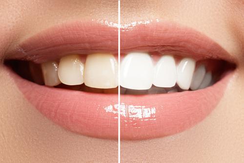 How-To-Whiten-Your-Teeth-Naturally-At-Home