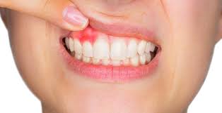Bleeding Gums: Causes, Natural Remedies & Best Toothpaste | Expert Advice