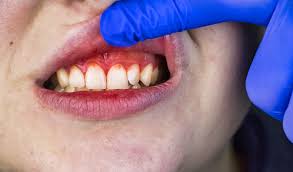 What Are Gum Disease And Gingivitis And How To Treat This?